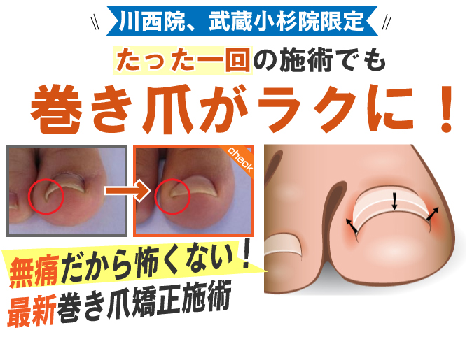 巻き爪の治療ならサンライズ鍼灸整骨院へ