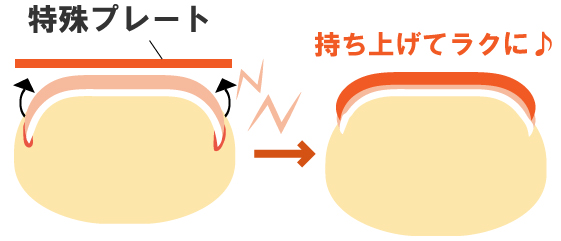 サンライズ鍼灸整骨院の巻き爪矯正