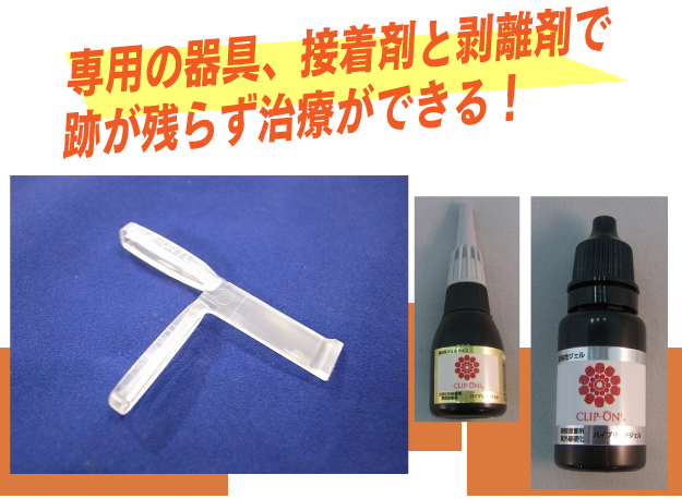 特殊プレートを使用して傷みなく治療